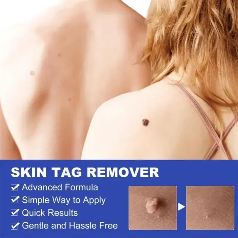 2 in 1 Painless Skin Tag Removal Kit Easy Home Use Mole Wart Remover Equipment Micro Skin Treatment Tool Beauty Skin Care Tool