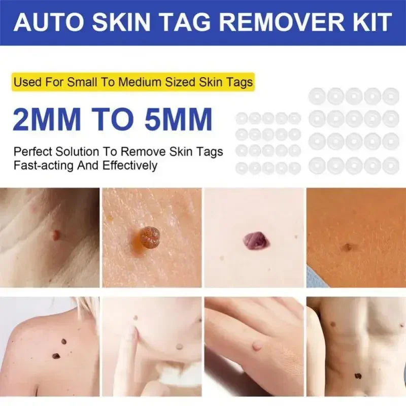 2 in 1 Painless Skin Tag Removal Kit Easy Home Use Mole Wart Remover Equipment Micro Skin Treatment Tool Beauty Skin Care Tool